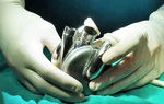 Úc phát triển thiết bị cấy ghép tim đột phá, mở ra hy vọng mới cho bệnh nhân suy tim