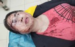 Người phụ nữ bị chồng kém 11 tuổi bạo hành dã man trước ngày ly hôn