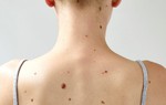 Làm thế nào để phân biệt đốm đồi mồi và ung thư da?