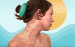 9 thay đổi lối sống đơn giản giúp giảm nhẹ viêm da dị ứng