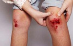 Làm thế nào để xác định xem con bạn có nguy cơ mắc bệnh máu khó đông hay không?