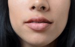 Chốc mép là bệnh gì? Chốc mép có lây không?