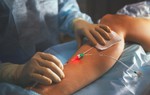 Tĩnh mạch nhân tạo hỗ trợ cấy ghép nội tạng