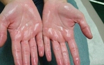 Trời nóng dễ đổ mồ hôi nhưng bác sĩ nhắc nhở 7 kiểu này là bệnh, gồm cả ung thư