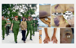 Người phụ nữ bị gia đình chồng cũ bạo hành dã man vì coi là "mầm họa" 