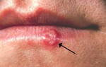 Bạn có thể bị mụn rộp do nhiễm virus Herpes khi đi bơi không?