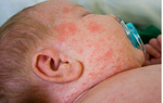 Nhiều trẻ mắc sởi, TPHCM kêu gọi phụ huynh cho con đi tiêm vaccine