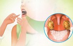 1 người tử vong do bệnh bạch hầu, Bộ Y tế yêu cầu tăng cường phòng, chống, không để bệnh lây lan trên diện rộng