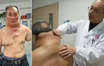 Madelung - căn bệnh hiếm gặp gây béo cổ ở đàn ông 