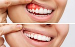 Các vấn đề về răng miệng có thể dẫn đến đột quỵ