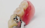 Đồng Nai: Gắp thành công 3 răng giả sau 6 ngày mắc kẹt trong thực quản nữ bệnh nhân 