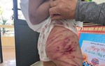 Bé gái lớp 5 nghi bị người thân bạo hành: Công an vào cuộc