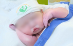 Cứu sống sản phụ sinh mổ lần 5 gặp biến chứng "rau cài răng lược"
