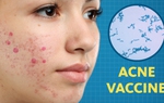 Mụn trứng cá không còn là ác mộng nhờ vắc-xin mới