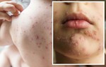 Những điều cần biết về bệnh thủy đậu ở trẻ em