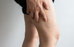 Cục máu đông ở chân: Dấu hiệu nhận biết và cách điều trị