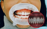 Lợi bị thâm đen có nguy hiểm không, cách điều trị thế nào?