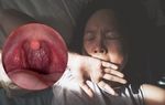 Đau họng khi ngáp là bệnh gì, có nguy hiểm không?