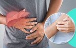 4 kiểu ngứa do ung thư gan thường bị nhầm là viêm da dị ứng