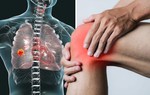 Cách nhận biết 4 dấu hiệu ung thư phổi ở chân dễ bị bỏ qua