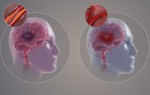 Phân loại bệnh mạch máu não và triệu chứng nhận biết sớm nhất