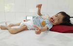 Bé gái 3 tuổi có khuôn mặt biến dạng vì dị tật mong chờ cơ hội được phẫu thuật