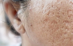 “Sẹo rỗ - Hiểu đúng, trị chuẩn”: Tránh “tiền mất tật mang” nhờ lời khuyên từ đội ngũ bác sĩ da liễu tại HKmedi