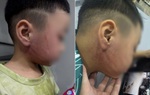 Bé trai 4 tuổi nghi bị cô giáo đánh tím mặt: Công an vào cuộc điều tra