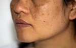 Sau tuổi 35, trị nám ở đâu để vừa an toàn vừa hiệu quả lâu dài?