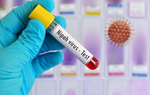 Virus Nipah: Cần giám sát dịch tễ sớm, ngăn chặn nguy cơ lây lan trong cộng đồng