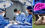 Dùng gan lợn biến đổi gen điều trị bệnh suy gan