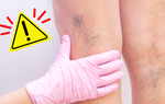 Tính mạng bị đe dọa vì giãn tĩnh mạch chi dưới khi mang thai