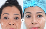 Công nghệ trẻ hóa khuôn mặt 5.5.10: Bí quyết trẻ ra 10 tuổi chỉ sau 90 phút mà không cần phẫu thuật