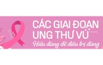 Ung thư vú: Hiểu đúng về các giai đoạn bệnh