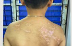 Bé trai 7 tuổi bị cha ruột đánh bằng dây sạc, thương tích 36%