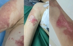 Người phụ nữ tố bị bỏng khi sử dụng dịch vụ tại spa ở Hà Nội