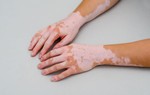 Ngày Bạch biến Thế giới 25/6: Nam và nữ đều có thể mắc, dù ở bất kỳ tuổi nào