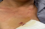 Súng tự chế cướp cò, người đàn ông bị đạn găm thẳng vào ngực