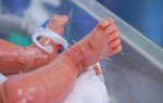 Bé trai sinh non mắc bệnh lý vảy cá bẩm sinh hiếm gặp