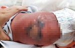 Bé sơ sinh bị bỏng nặng, nhiễm trùng máu khi nằm hơ than cùng mẹ