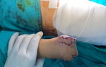 Học chế pháo nổ trên mạng, bé trai 13 tuổi ở Thanh Hóa bị dập nát bàn tay phải