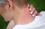5 mẹo xử lý côn trùng cắn nhanh gọn hiệu quả