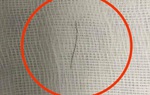 Bé 13 tháng tuổi nuốt phải mảnh thép 2cm sau khi ăn cháo mua sẵn