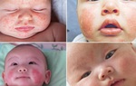 Cách chữa chàm sữa ở trẻ sơ sinh an toàn, hiệu quả nhanh
