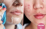 Những nguyên tắc chăm sóc da mụn bạn cần nằm lòng để có làn da căng mịn, trắng sáng