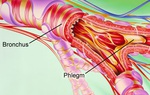 Cách nhận biết và phòng ngừa khi viêm phế quản mãn tính biến chứng thành bệnh phổi tắc nghẽn mãn tính