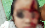 Bé 6 tuổi bị chó cắn nát mặt