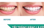 Tẩy trắng răng có hại gì với sức khỏe và có đau không?