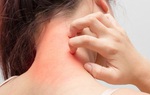 9 điều cần biết về chứng ngứa da