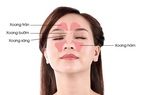 Tìm hiểu biến chứng viêm xoang do cảm lạnh
